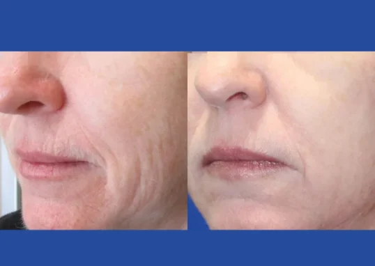 fractional-rf-microneedling