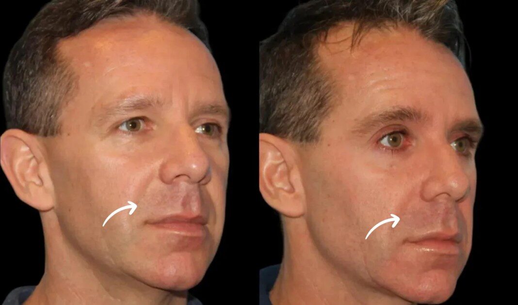 sculptra fillers in dubai