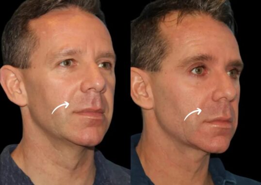 sculptra fillers in dubai