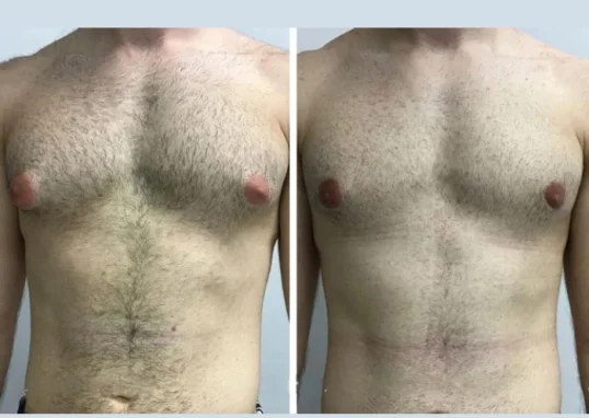 Gynecomastia in Dubai