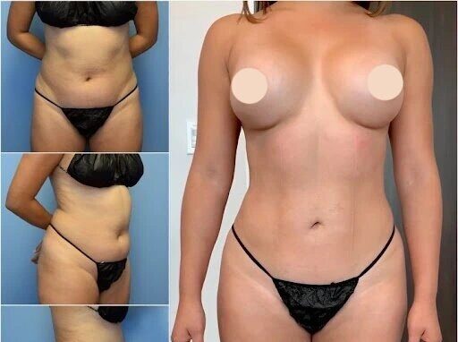 Body Contouring in Dubai