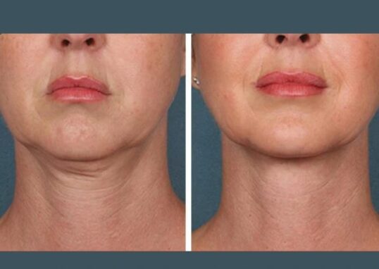 Prp Treatment in Dubai