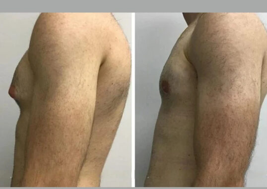 Gynecomastia Surgery in Dubai