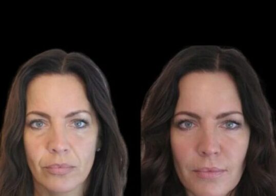 Jawline fillers in Dubai