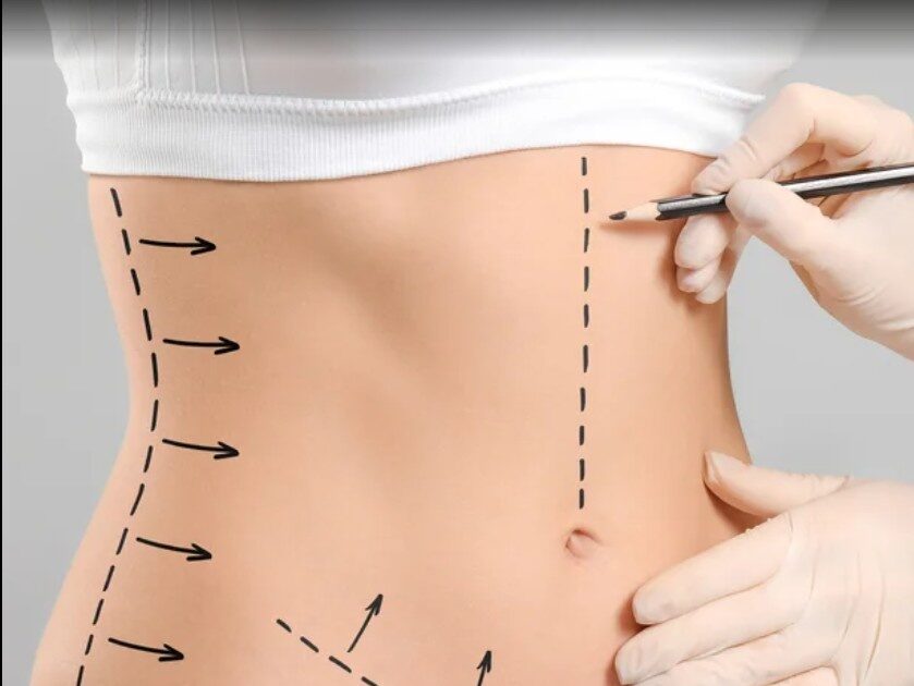 Tummy Tuck In Dubai
