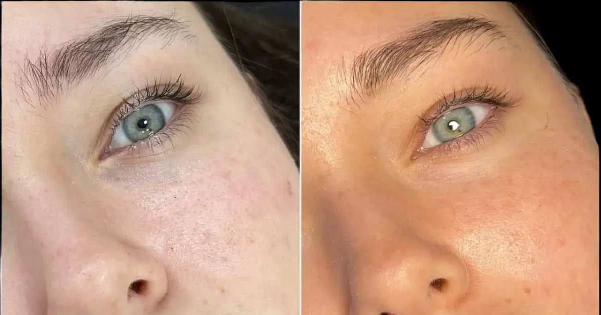 Dermal Fillers in Dubai