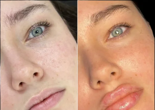 Dermal Fillers in Dubai