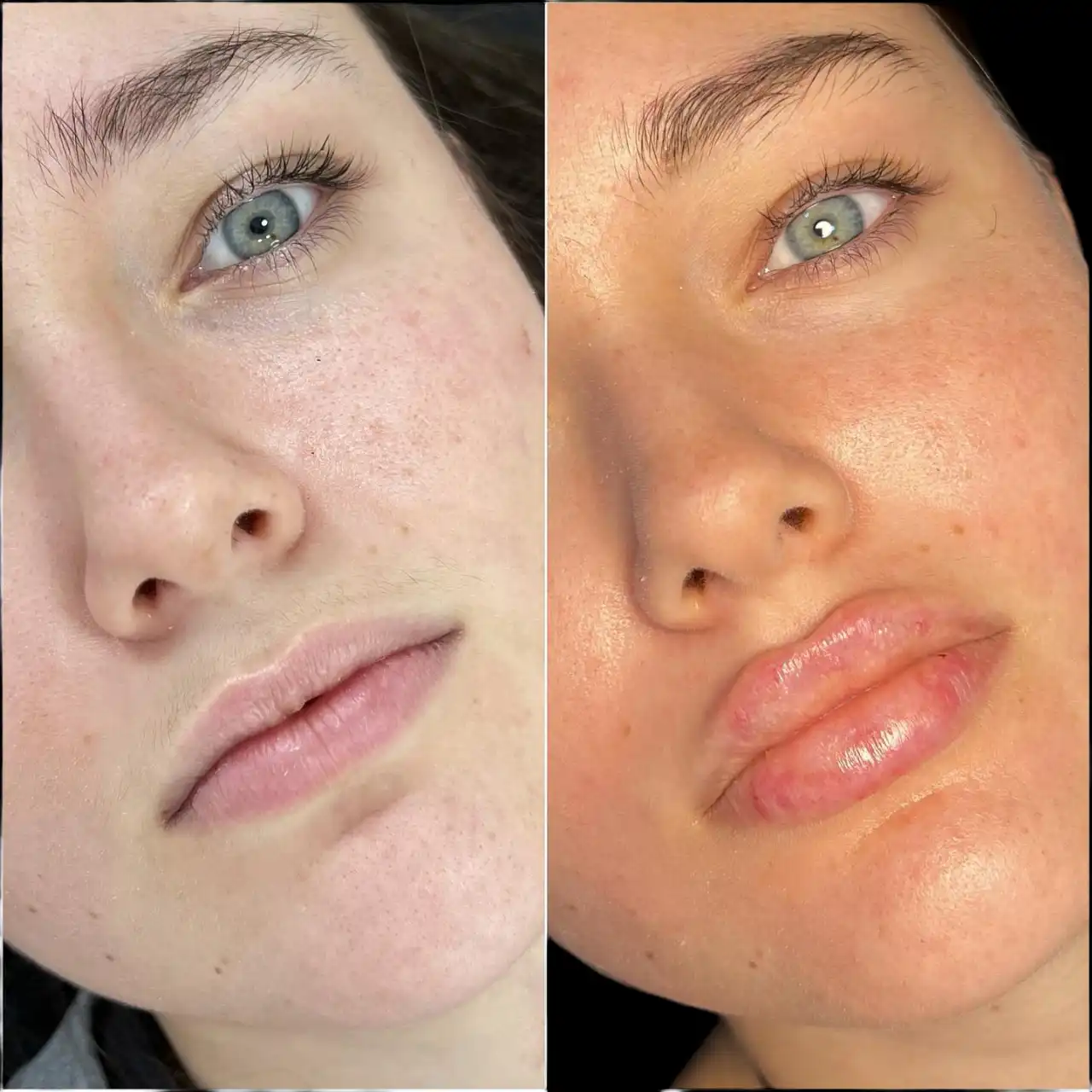 Dermal Fillers in Dubai