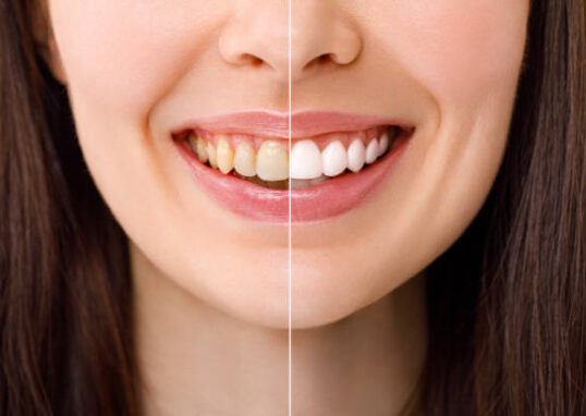Teeth Whitening in Riyadh
